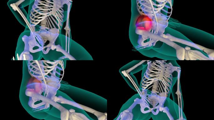 胯骨疼痛3D模型