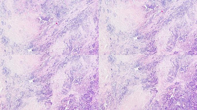 膀胱移行细胞癌显微镜下不同区域放大