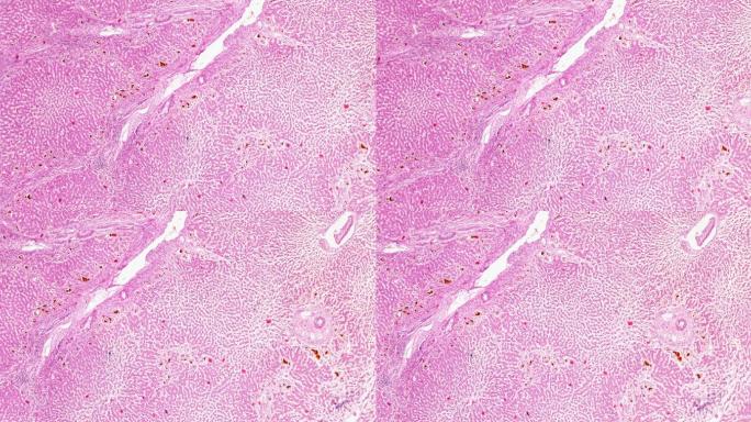 急性重型肝炎的光镜观察