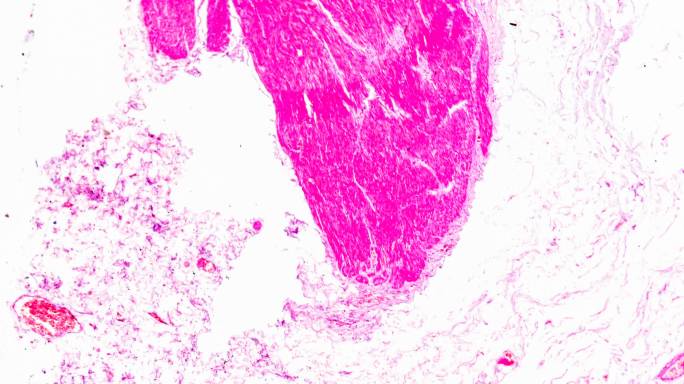 胃腺癌（高度分化的管状腺癌）在光学显微镜下可放大不同区域