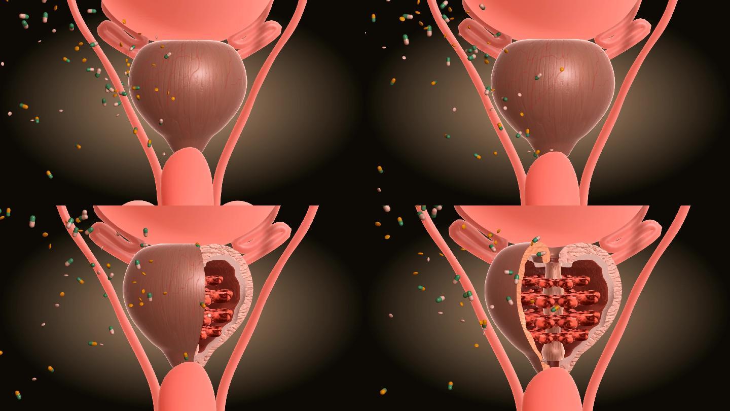 前列腺包膜腺管外用给药更是有心无力