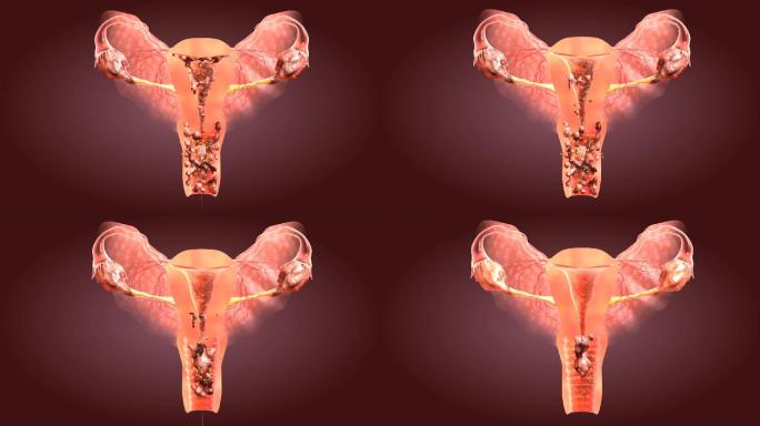 宫颈炎子宫排出的脓性分泌物逐渐减少