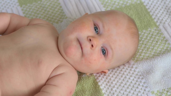 婴儿与过敏宝宝皮肤过敏