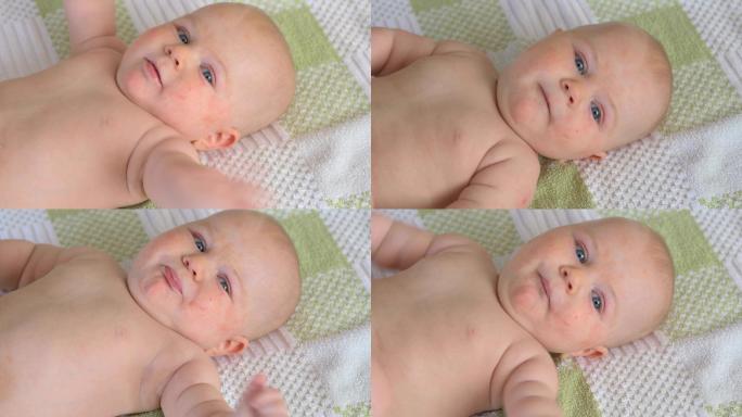婴儿与过敏宝宝皮肤过敏