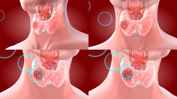 针对已经明确的甲状腺病灶靶位点