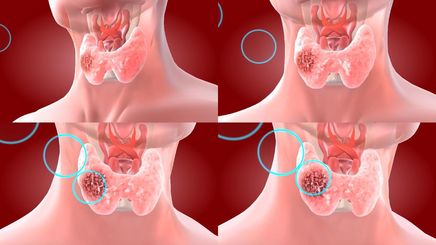 针对已经明确的甲状腺病灶靶位点