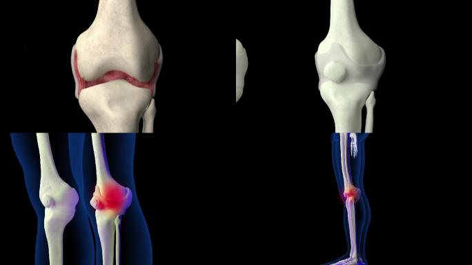 膝关节滑膜炎3D动画