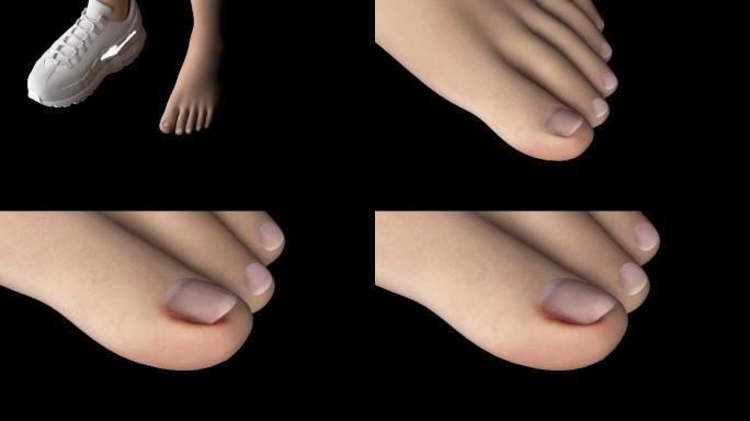 脚指甲长进肉里3D动画