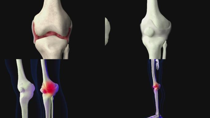 膝关节滑膜炎3D动画