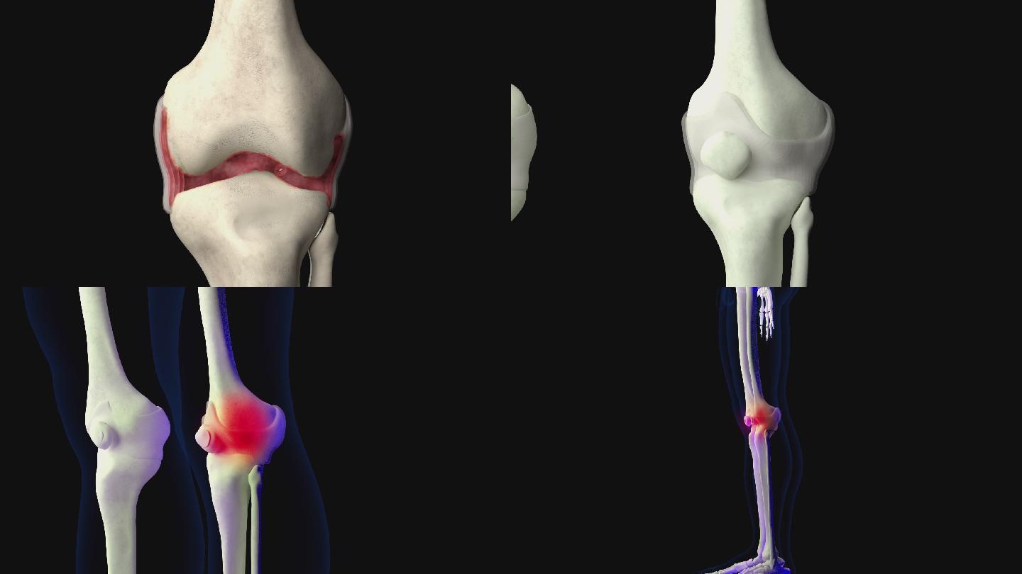 膝关节滑膜炎3D动画