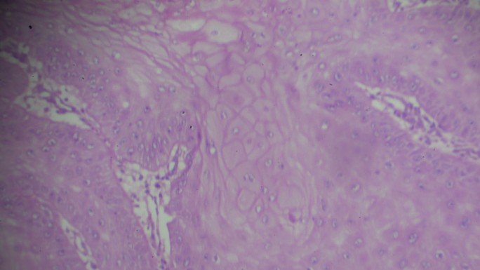 显微镜下鳞状细胞癌，不同区域和
