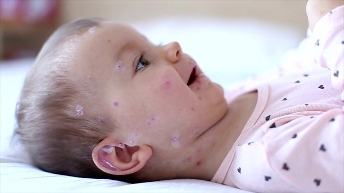 麻疹哭闹女婴为患者看病治疗诊断医学检查