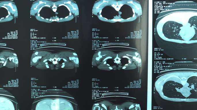 25-29岁男性的人体X射线图像平移图，包括弓箭步和胸部，MRI扫描疑似肺结核和肺炎