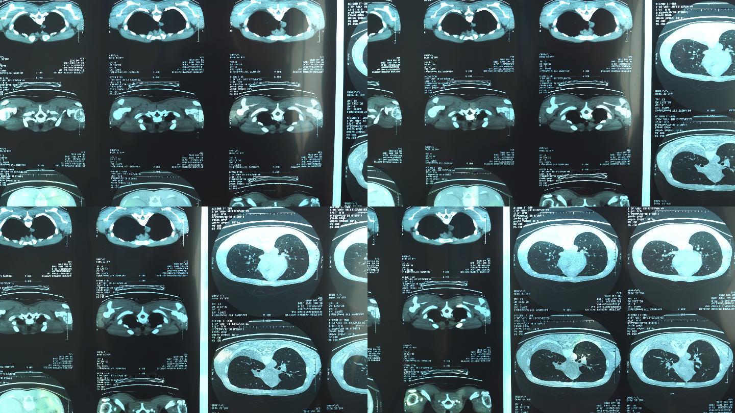 25-29岁男性的人体X射线图像平移图，包括弓箭步和胸部，MRI扫描疑似肺结核和肺炎