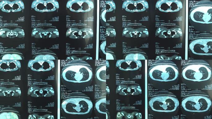 25-29岁男性的人体X射线图像平移图，包括弓箭步和胸部，MRI扫描疑似肺结核和肺炎