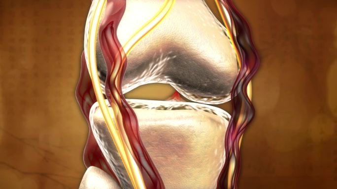 风寒湿邪导致关节血淤形成骨刺压迫神经血管