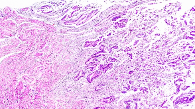 子宫内膜癌生物标本显微镜下不同范围放大