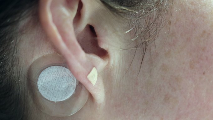 针灸磁铁治疗耳鸣的女性特写镜头