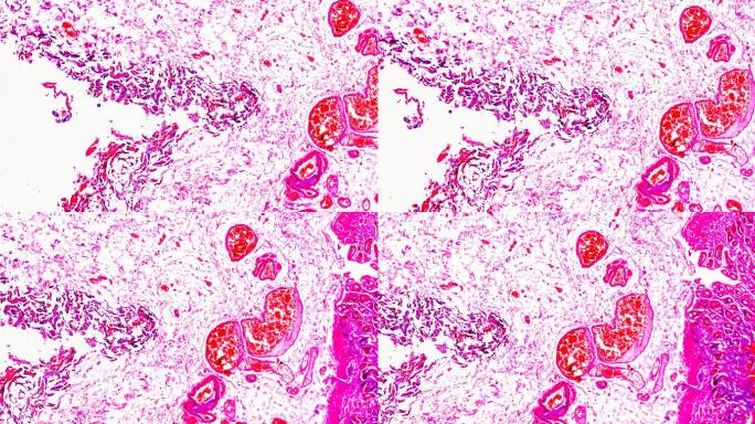 胃腺癌（高度分化的管状腺癌）在光学显微镜下可放大不同区域