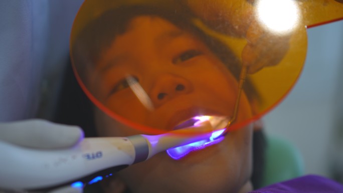 牙医医生的手正在牙科诊所为6岁亚洲小孩患者的牙齿进行补牙，牙医使用紫外线对男孩的牙齿进行手持。