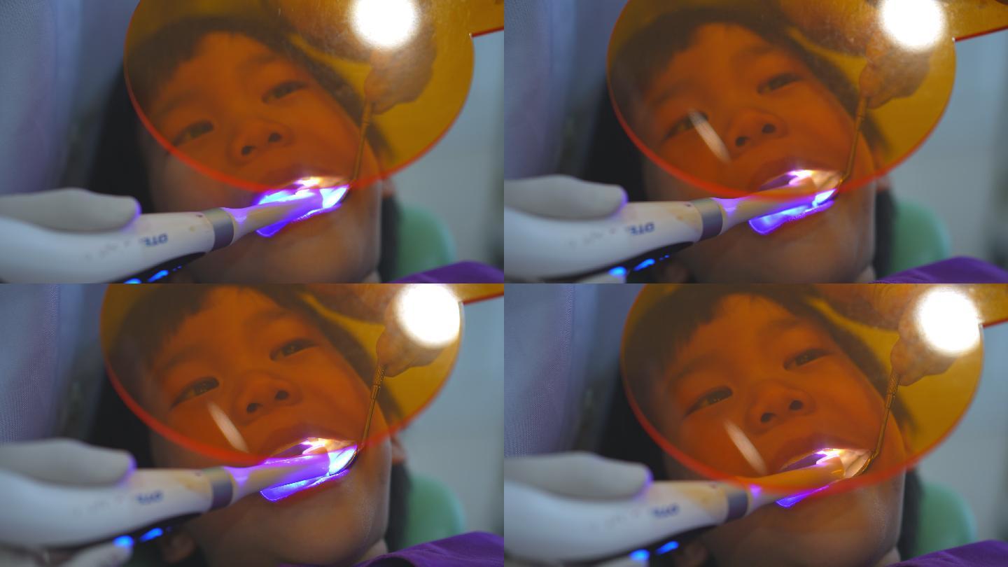 牙医医生的手正在牙科诊所为6岁亚洲小孩患者的牙齿进行补牙，牙医使用紫外线对男孩的牙齿进行手持。