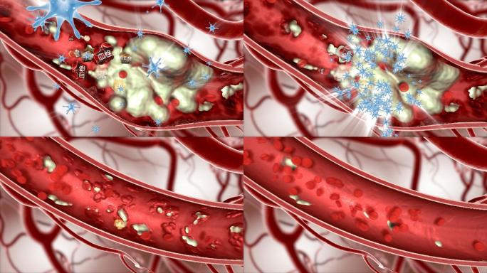 净化血管 血栓 胆固醇 甘油三酯