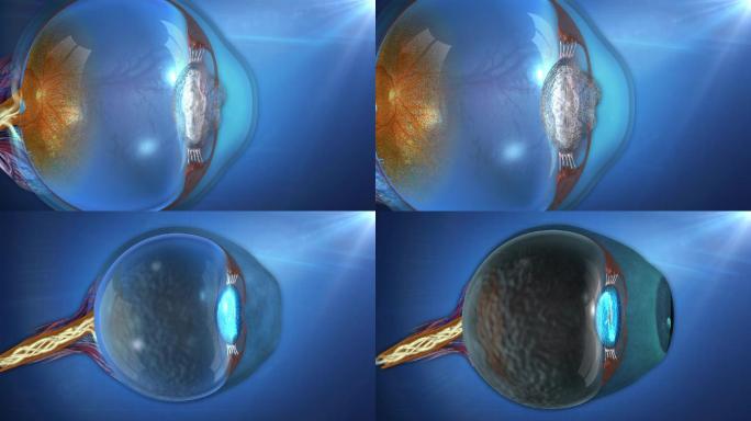 白内障、青光眼、糖尿病并发眼病病因部位