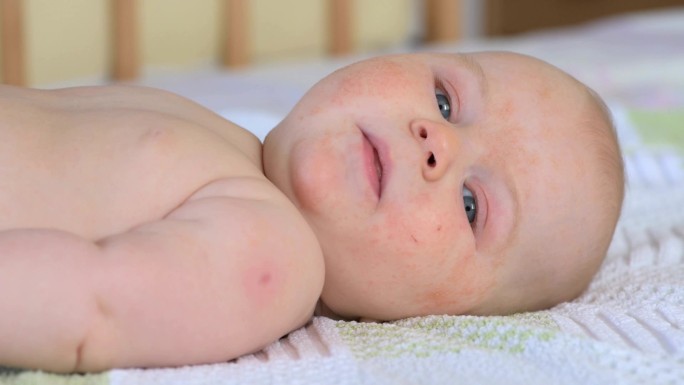 婴儿与过敏湿疹婴儿皮肤