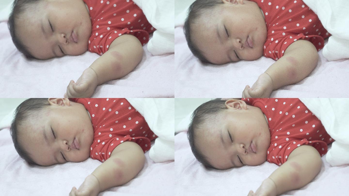 皮肤上有红色斑点的熟睡女婴。孩子生病了。