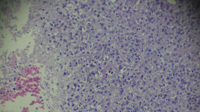 睾丸生殖细胞瘤的光镜观察