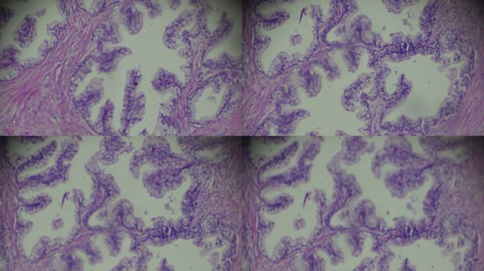 光镜下前列腺肥大活检