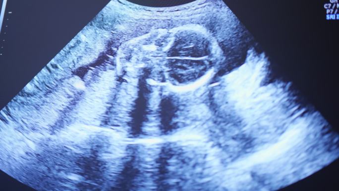 婴儿吮吸拇指超声X射线