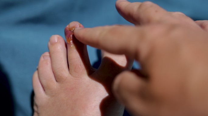 一个男人在肿胀和擦伤的脚趾上涂抹软膏