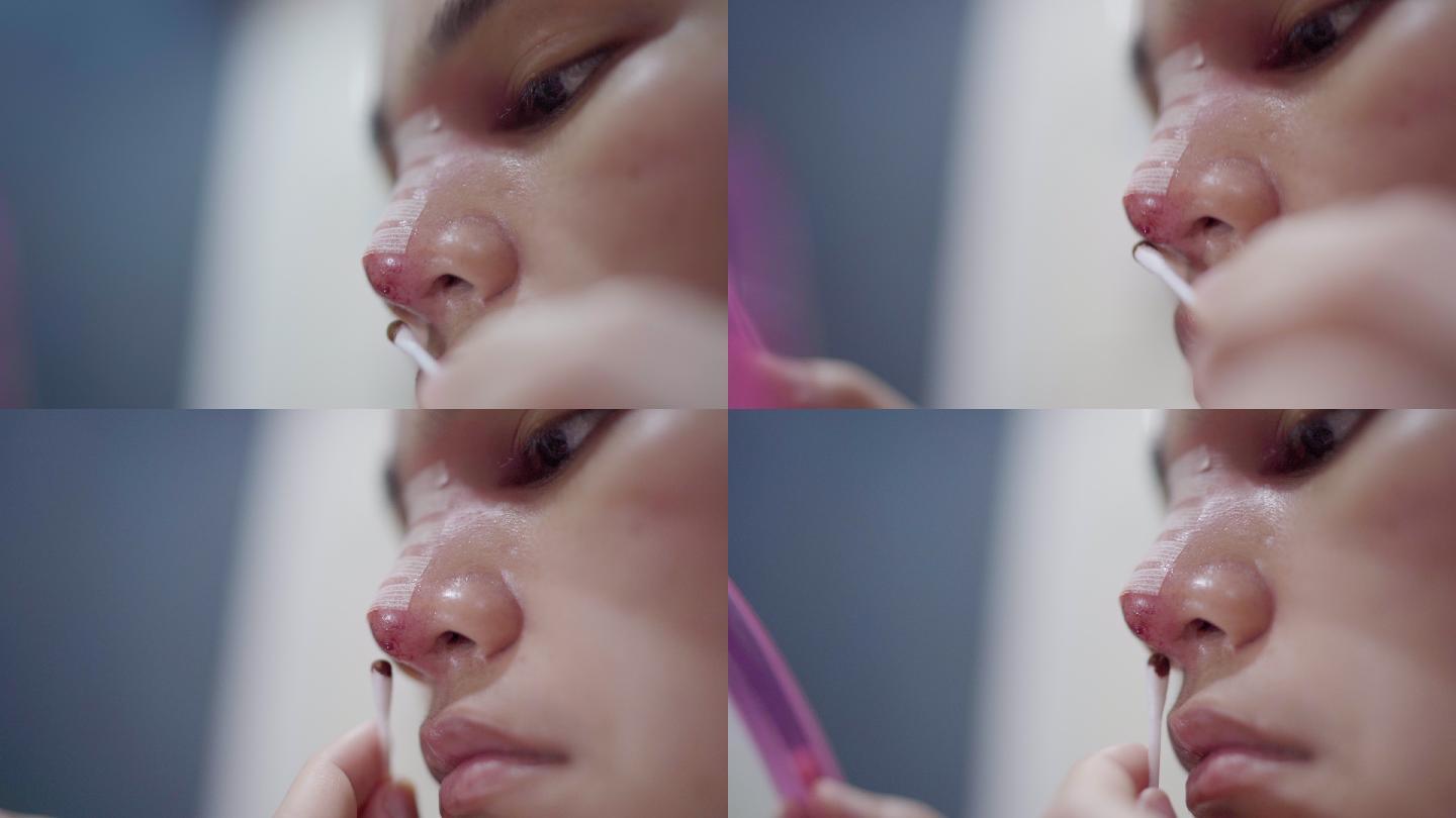 鼻整形术，她清洗伤口。