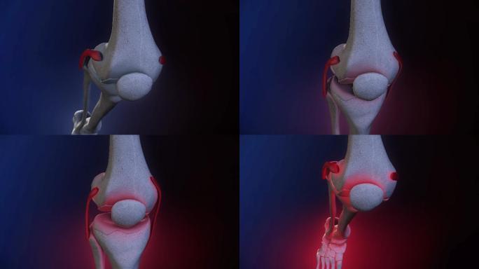 膝盖疼痛医学分医学知识医学动画演示