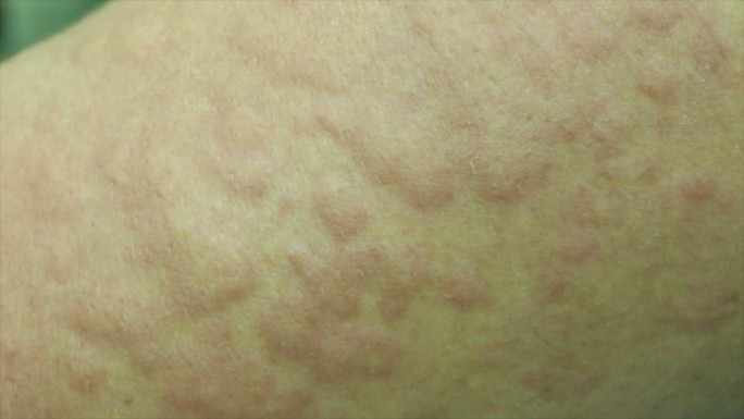 荨麻疹。皮肤病