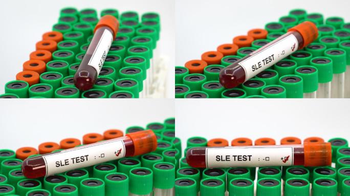 系统性红斑狼疮（SLE）阳性