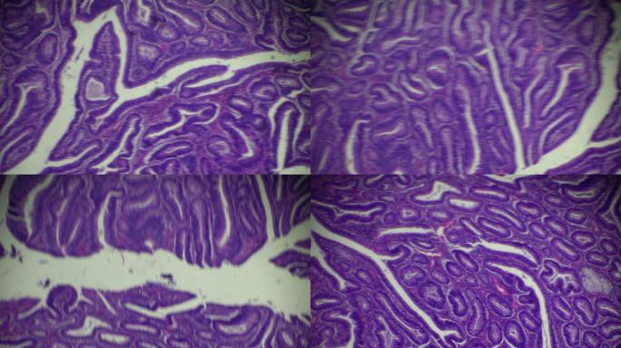 显微镜下的大肠癌（高度分化的管状腺癌）