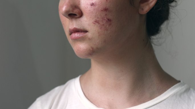 脸上有痤疮的女人伤痕