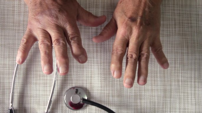 骨性关节炎老人的手在医生的办公室里移动手指