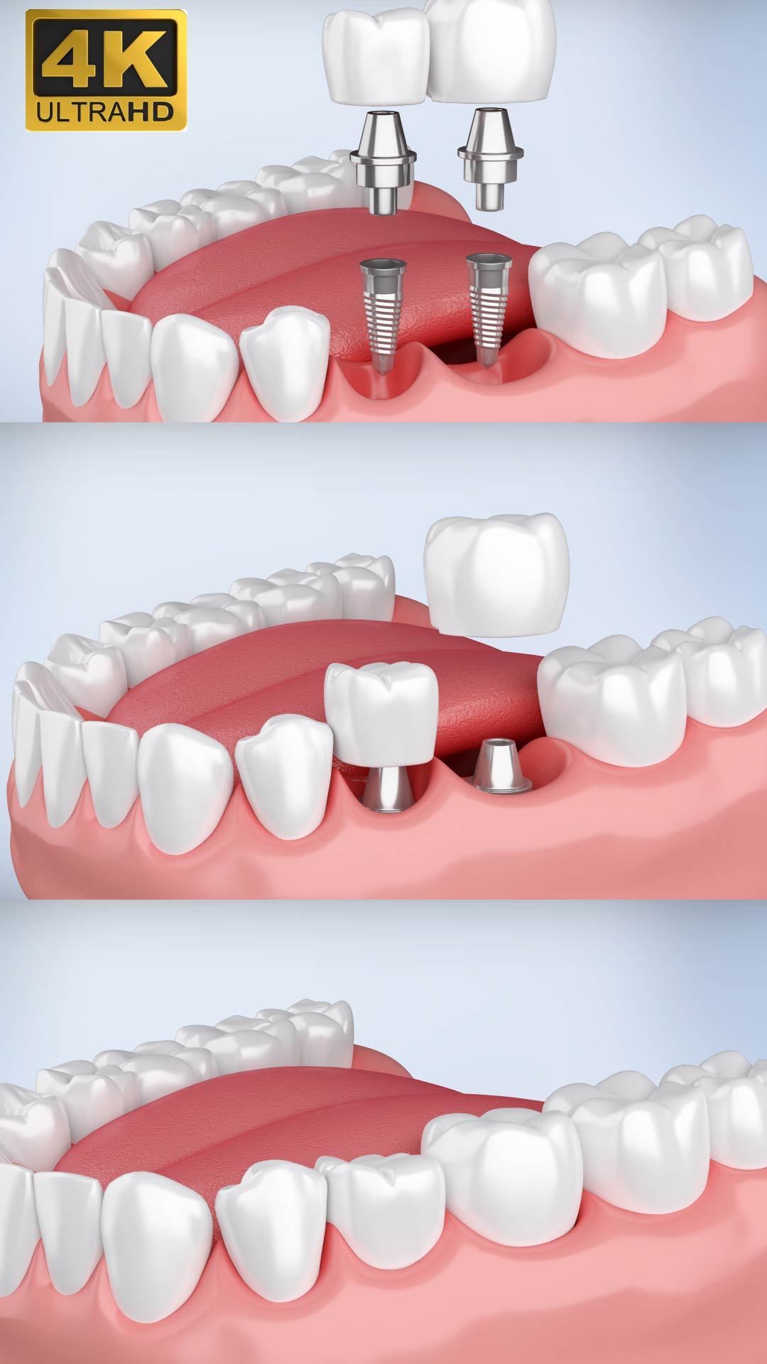牙齿固定修复价格-爱康健齿科