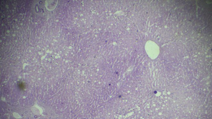 肝脏脂肪变性镜下可见圆形脂肪沉积