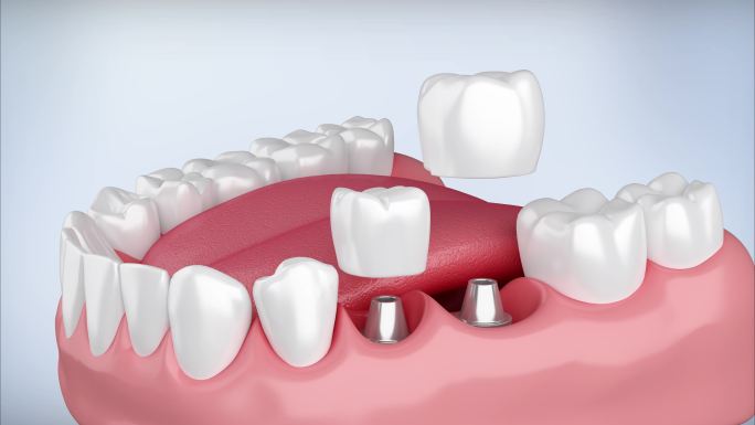 镶牙 种植牙 牙齿 牙科