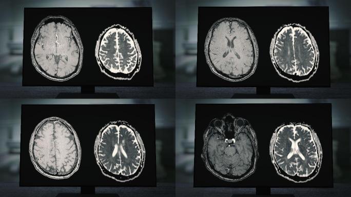 磁共振成像（MRI）监视器上的CT脑扫描图像