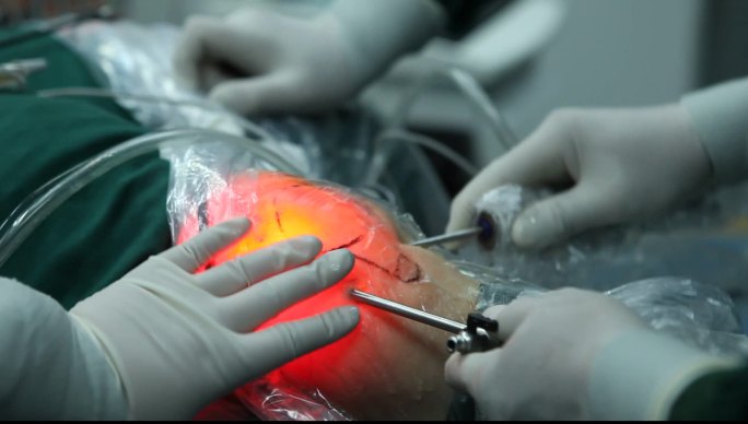 骨科针刀镜可视技术特写手术过程中