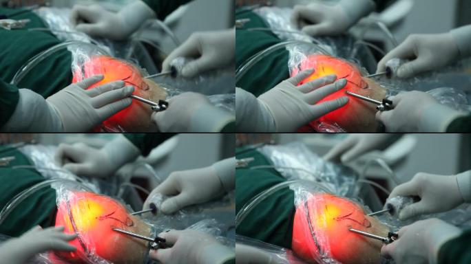 骨科针刀镜可视技术特写手术过程中