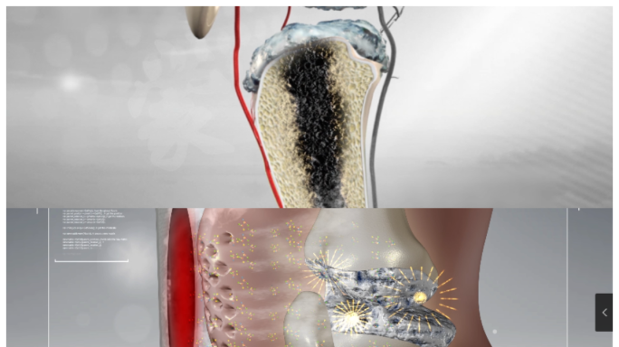 骨毒骨刺 骨关节动画 药物修复动画