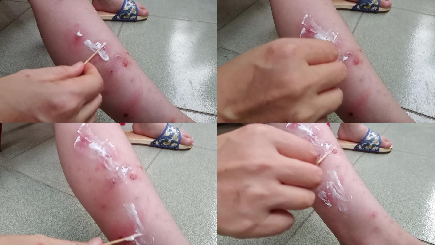孩子小腿皮肤上长满了疮痍疮脓涂上消炎药膏
