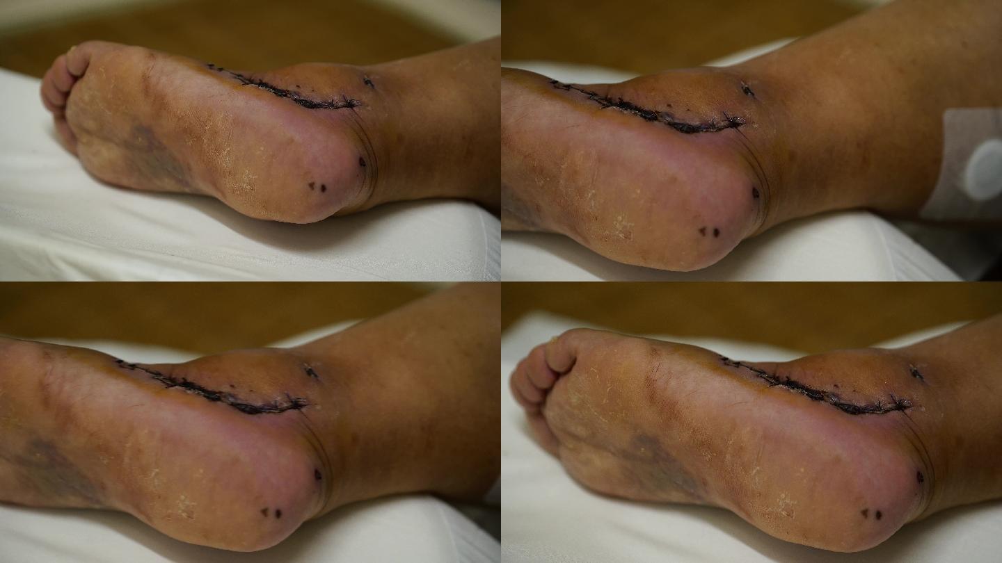 4K脚踝骨折手术后康复的病人腿部空镜