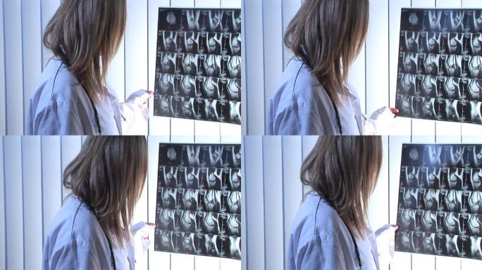 护士看X光片特写查验病灶位置病患光片结果